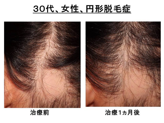 円形脱毛症　病院""